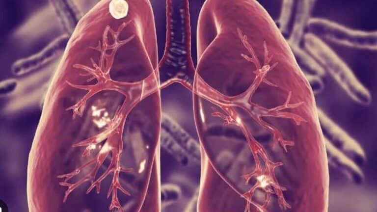 3 People in Maine Have Active Tuberculosis