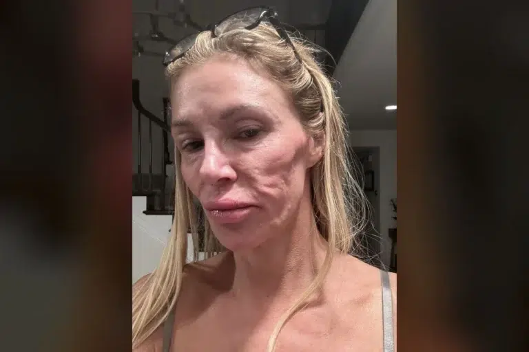 Brandi Glanville: I have sexually transmitted ringworm in my throat