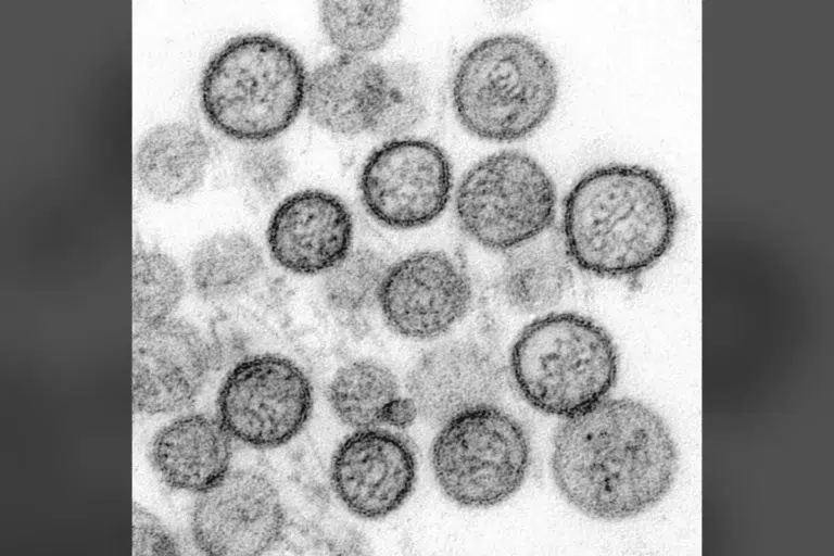 Not Just Cruise Ships: Hantavirus Hits Midwest, Oregon Doctor Not Just Cruise Ships: Hantavirus Hits Midwest, Oregon Doctor