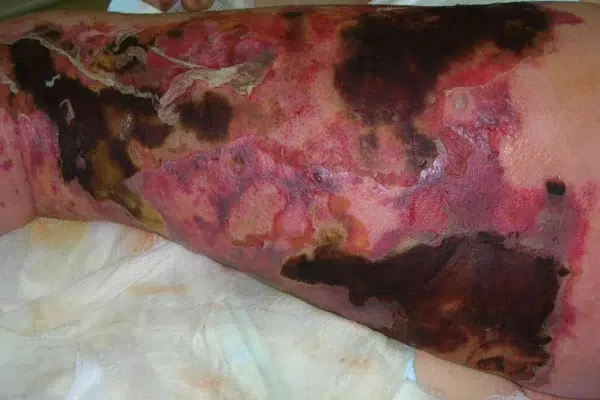 97% Fatal: Flesh-Eating Amoeba Strikes Arizona 12-Year-Old