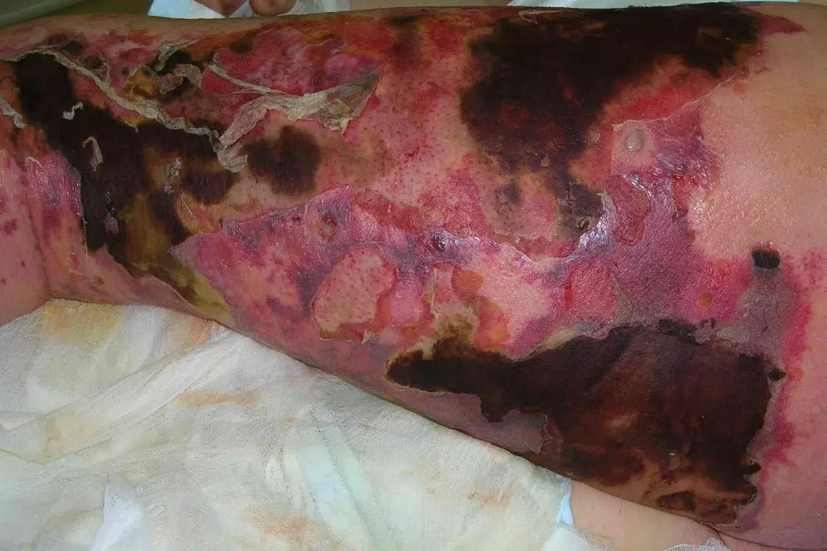 97% Fatal: Flesh-Eating Amoeba Strikes Arizona 12-Year-Old