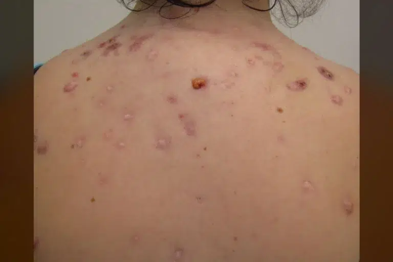 Bacne is not 'just sweat.' Dermatologists reveal the real cause. Bacne is not 'just sweat.' Dermatologists reveal the real cause.