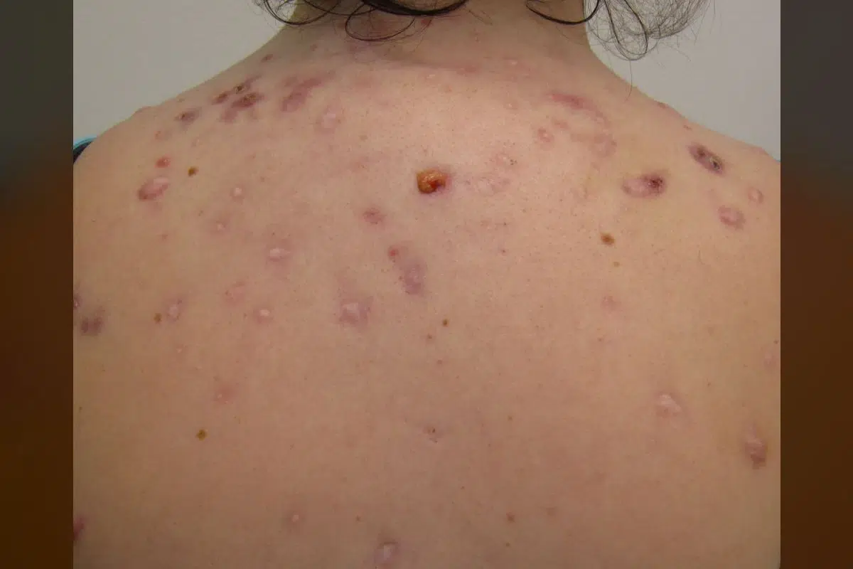 Bacne is not 'just sweat.' Dermatologists reveal the real cause.